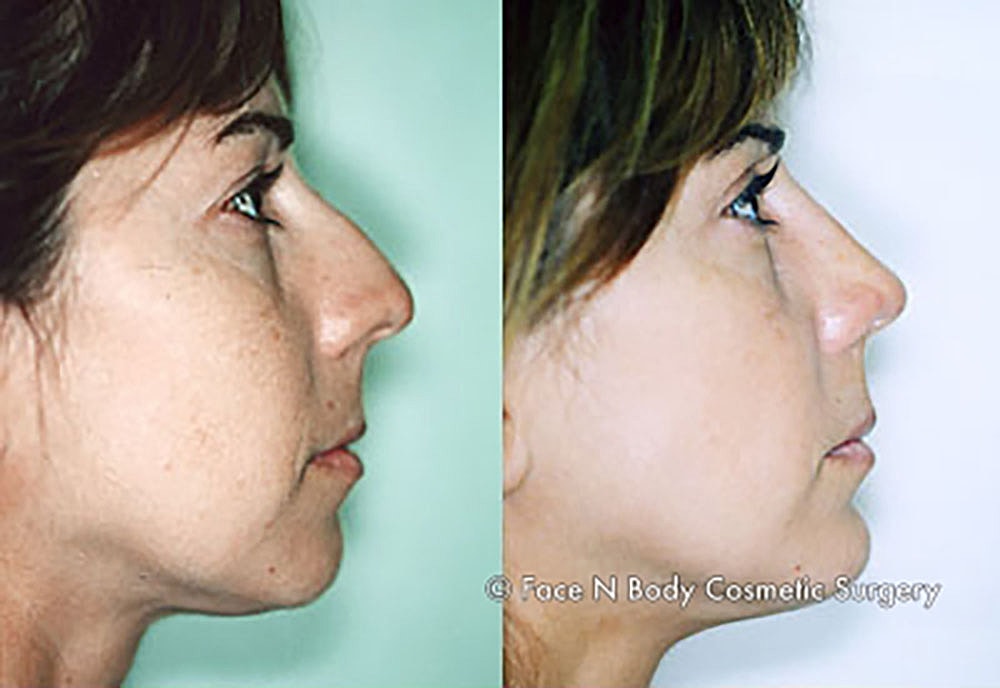 Chin Augmentation Before & After
