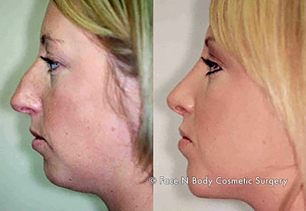 Chin Augmentation Before & After