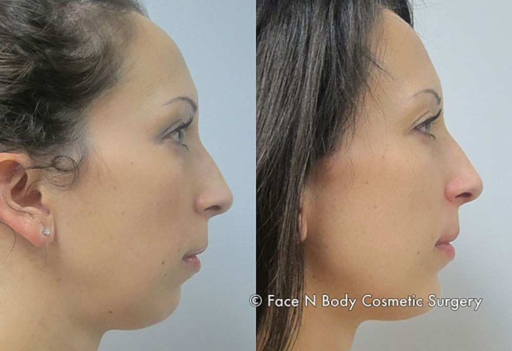 Chin Augmentation Before & After