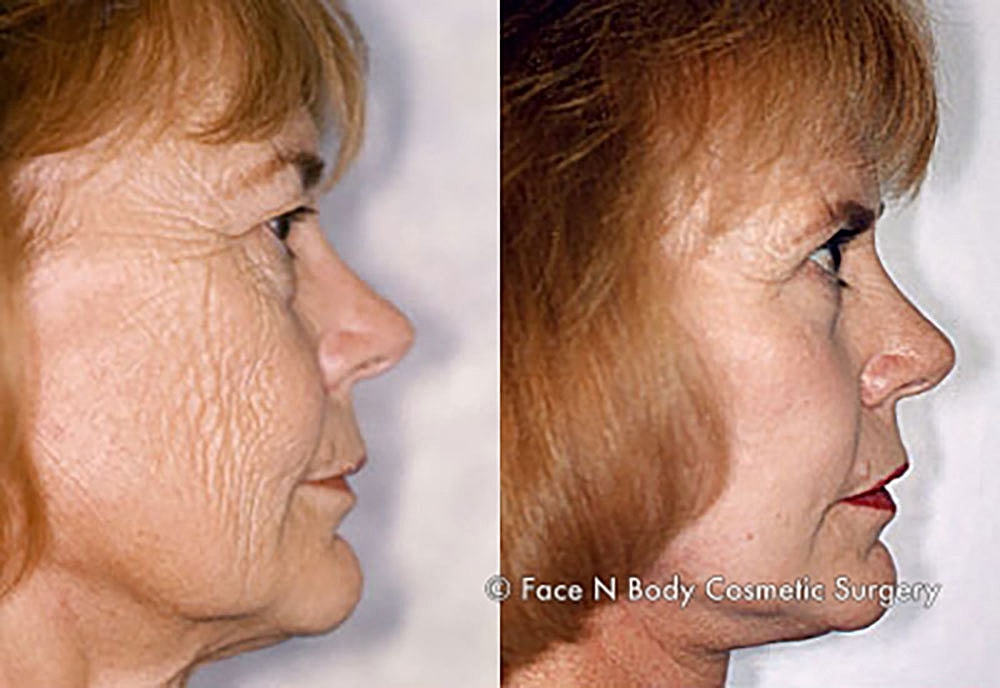 Chemical Peels Before & After