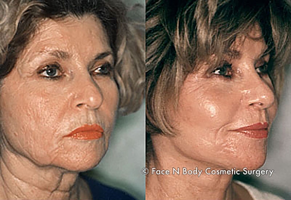 Chemical Peels Before & After