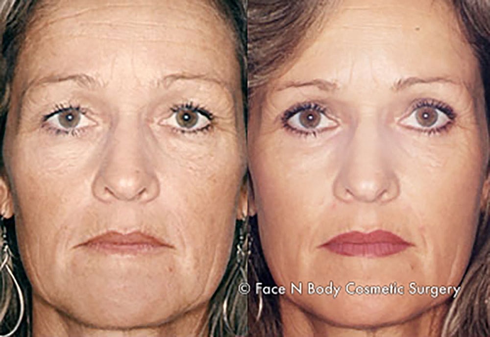 Chemical Peels Before & After