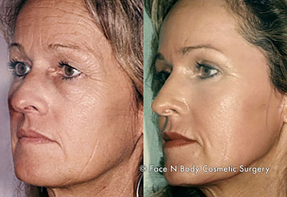 Chemical Peels Before & After