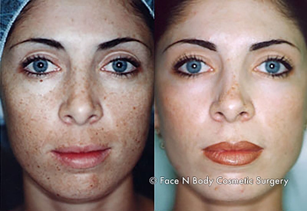 Chemical Peels Before & After