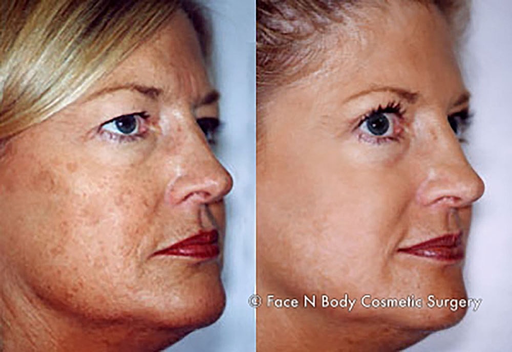 Chemical Peels Before & After
