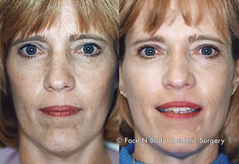 Chemical Peels Before & After