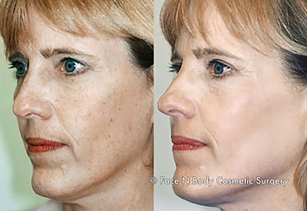 Chemical Peels Before & After