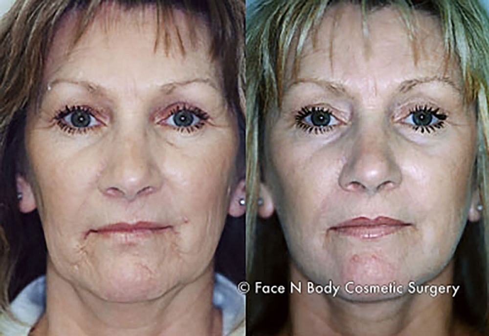 Chemical Peels Before & After
