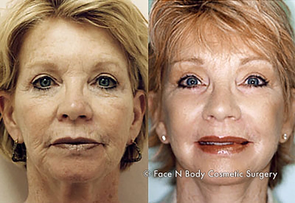 Chemical Peels Before & After