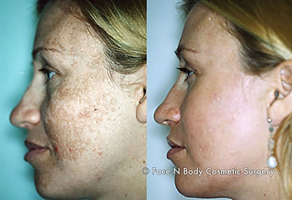 Chemical Peels Before & After