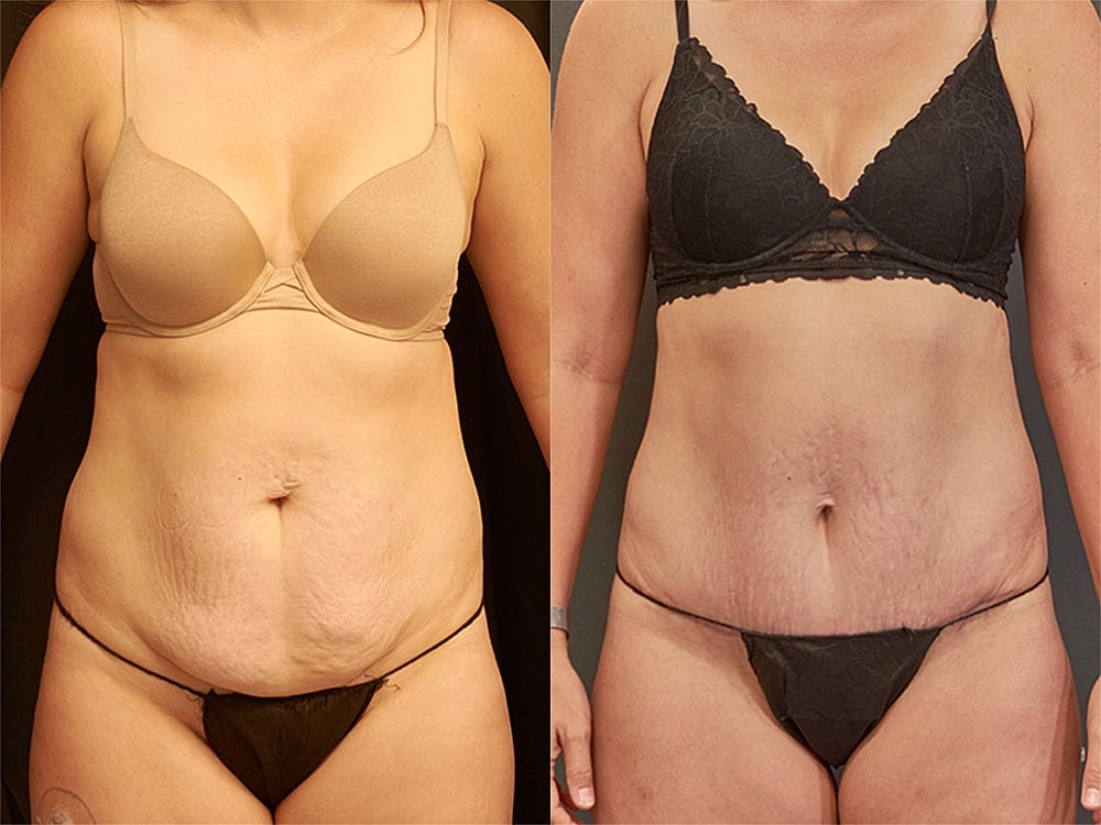 Contoured Abdominoplasty Before & After