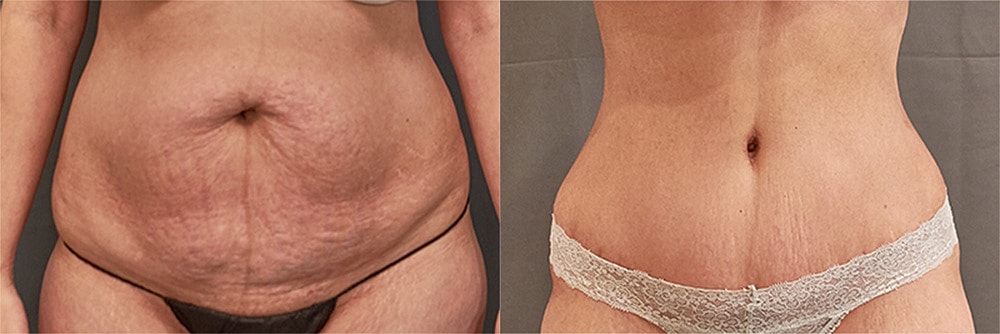 Contoured Abdominoplasty Before & After