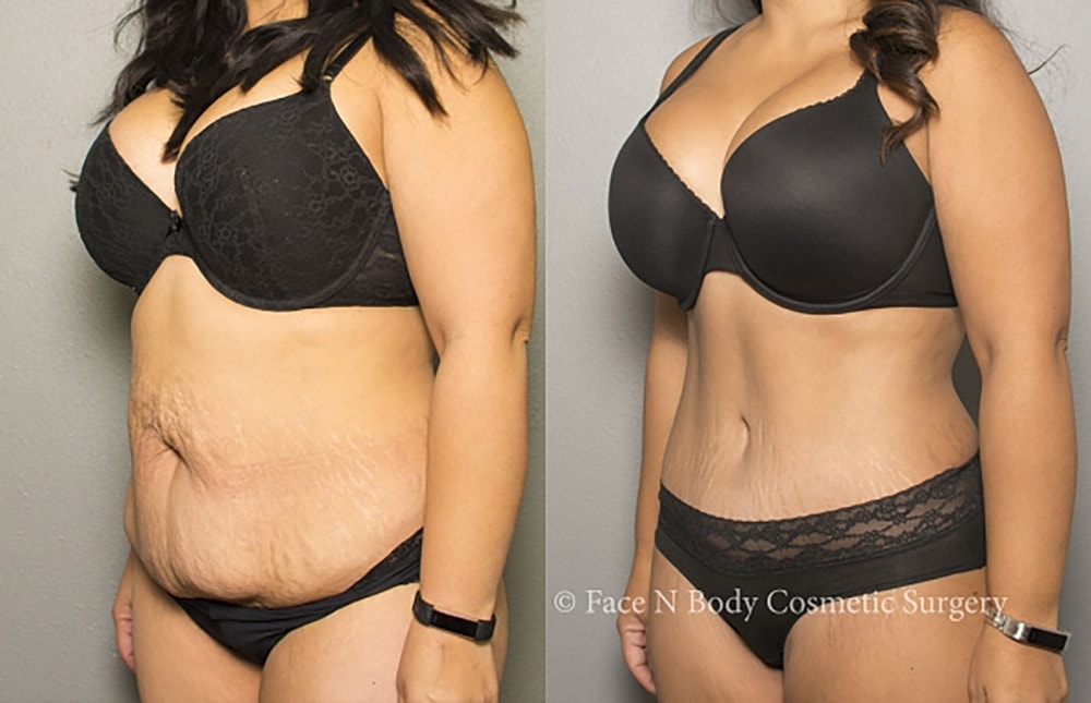 Contoured Abdominoplasty Before & After
