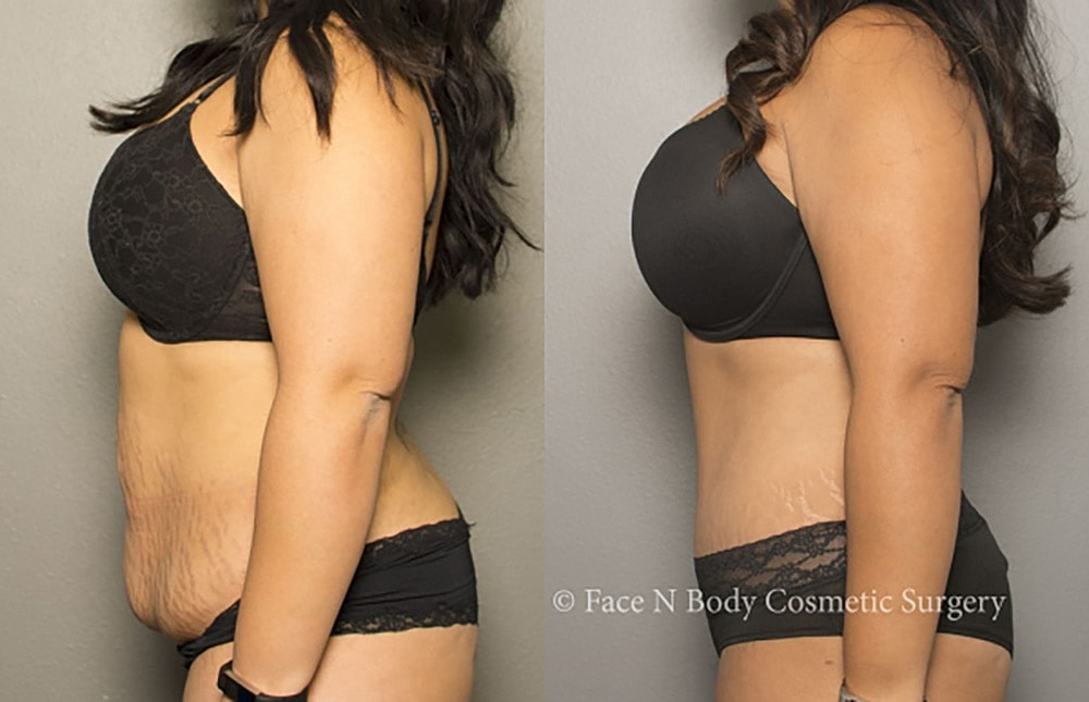 Contoured Abdominoplasty Before & After