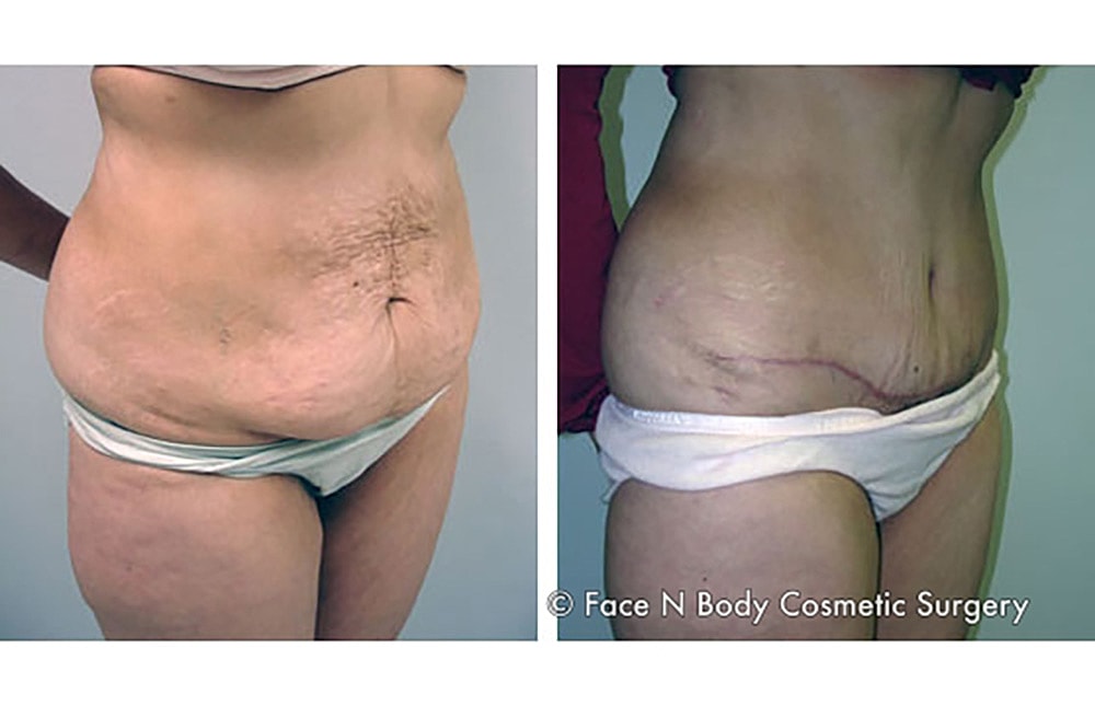 Contoured Abdominoplasty Before & After
