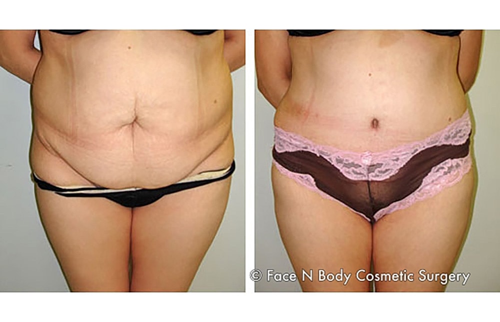 Contoured Abdominoplasty Before & After