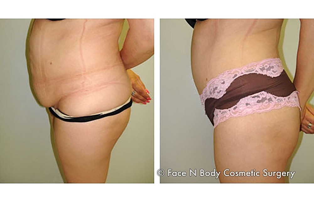 Contoured Abdominoplasty Before & After