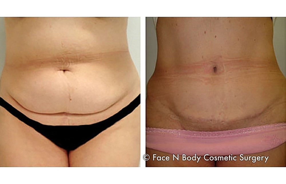 Contoured Abdominoplasty Before & After