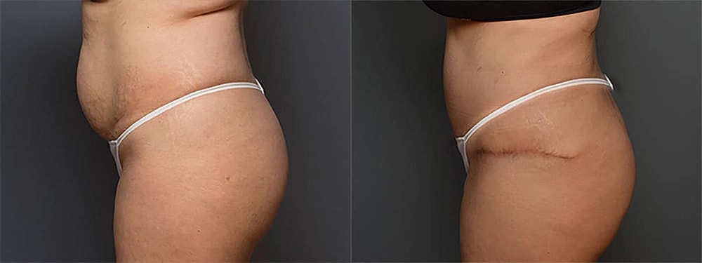 Contoured Abdominoplasty Before & After