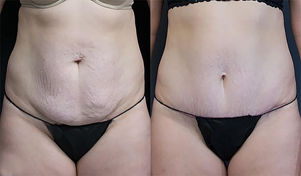 Contoured Abdominoplasty Before & After