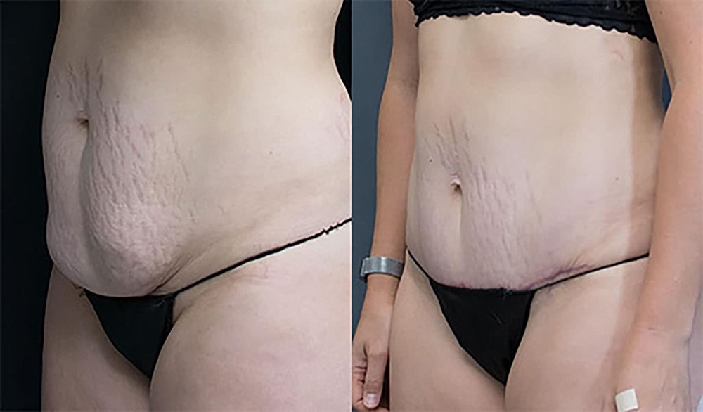 Contoured Abdominoplasty Before & After