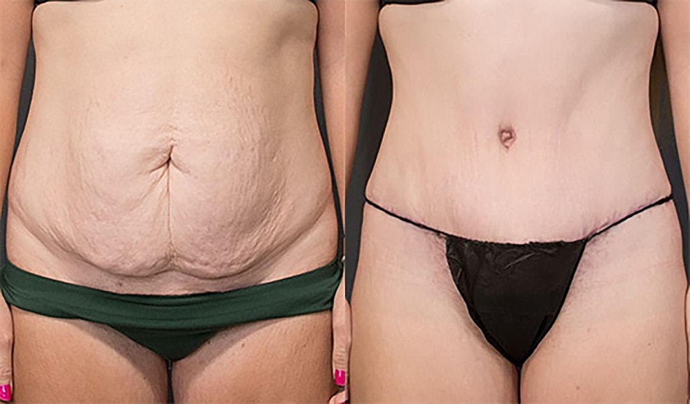 Contoured Abdominoplasty Before & After
