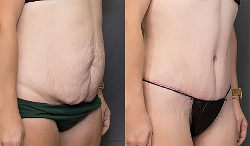 Contoured Abdominoplasty Before & After