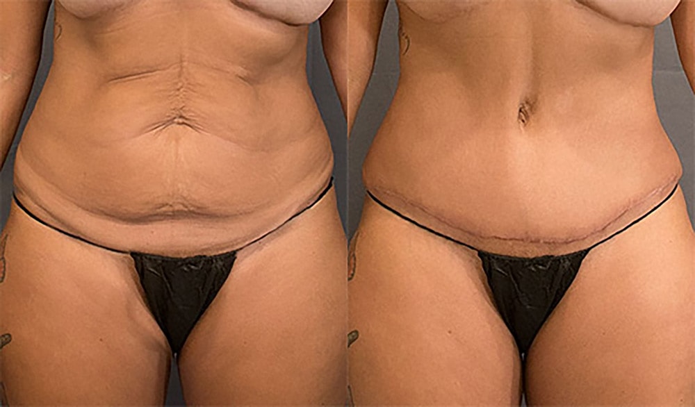 Contoured Abdominoplasty Before & After