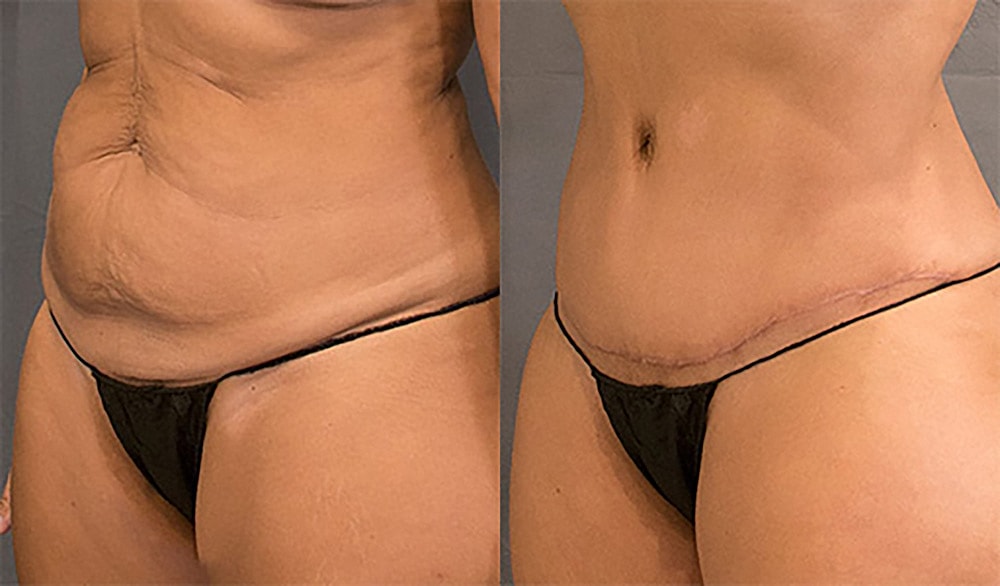 Contoured Abdominoplasty Before & After