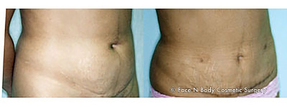 Contoured Abdominoplasty Before & After