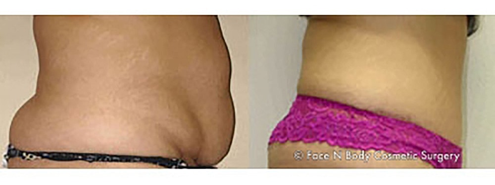 Contoured Abdominoplasty Before & After