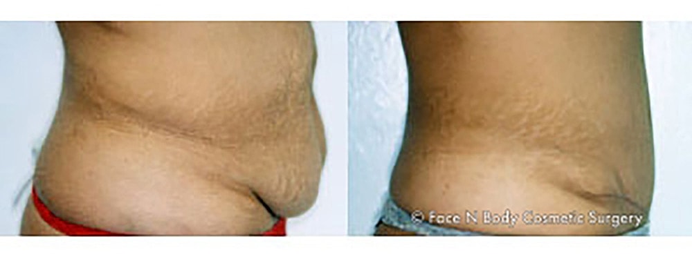 Contoured Abdominoplasty Before & After