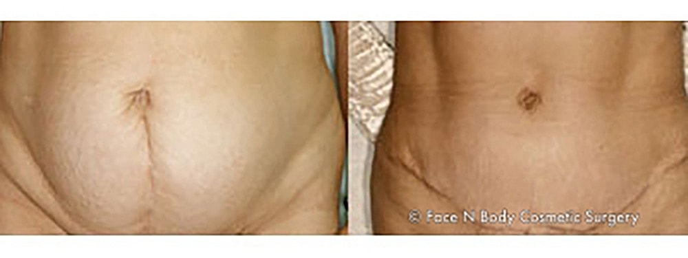 Contoured Abdominoplasty Before & After
