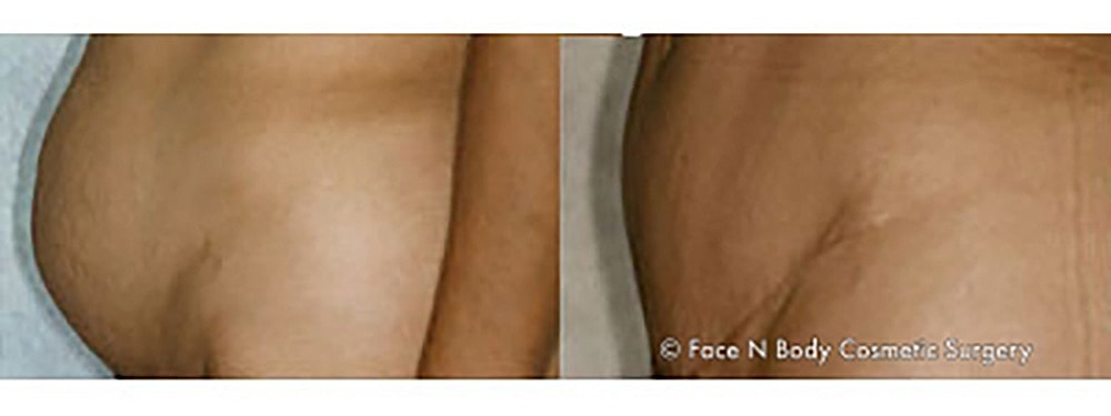 Contoured Abdominoplasty Before & After