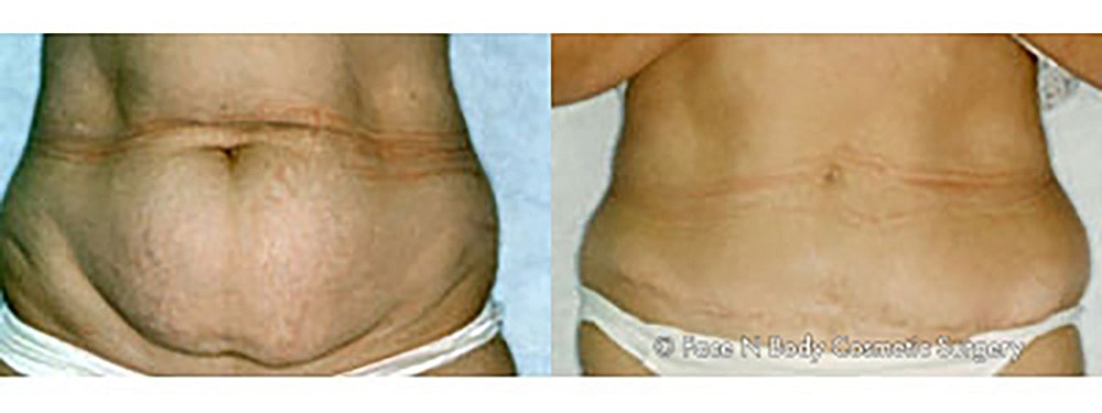 Contoured Abdominoplasty Before & After