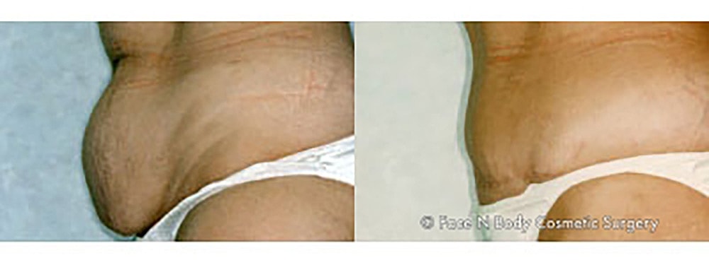 Contoured Abdominoplasty Before & After