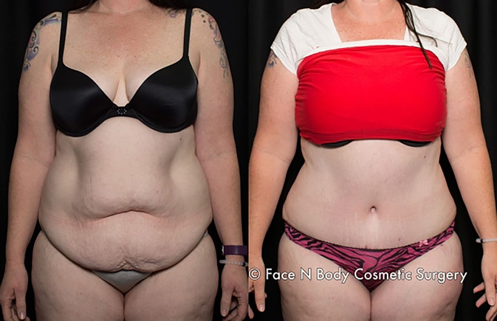 Contoured Abdominoplasty Before & After