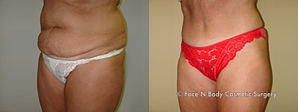 Contoured Abdominoplasty Before & After
