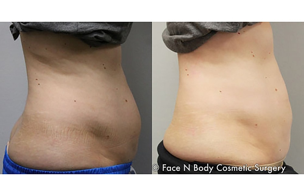 Contoured Abdominoplasty Before & After
